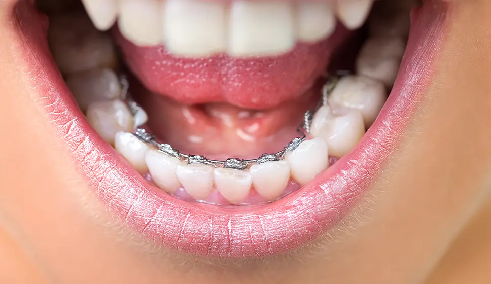 歯の裏側に装着する舌側矯正装置